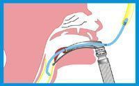 Intubation Aids - Bougies -Introducers - Magil forceps- Stylettes